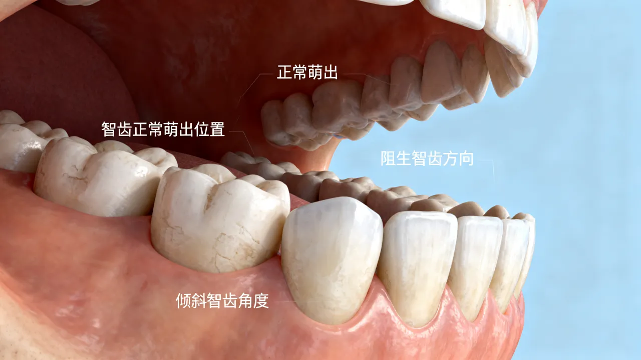 长智齿真的决定命运吗,智齿生长位置有何预兆 长智齿真的决定命运吗,智齿生长位置有何预兆