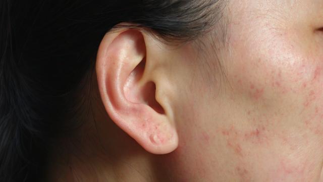 瘊子真的会影响人的运气吗？